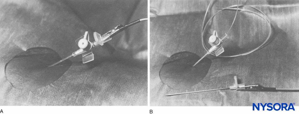 A: Placement of the infusion cannula. Nerve stimulator attached to the trocar (lateral view). B: The catheter is inserted through the infusion cannula (lateral view). (Reproduced with permission from Anker-Møller E1, Spangsberg N, Dahl JB, et al: Continuous block of the lumbar plexus after knee surgery: a comparison of the plasma concentrations and analgesic effect of bupivacaine 0.250% and 0.125%. Acta Anaesthesiol Scand. 1990 Aug;34(6):468-472.)