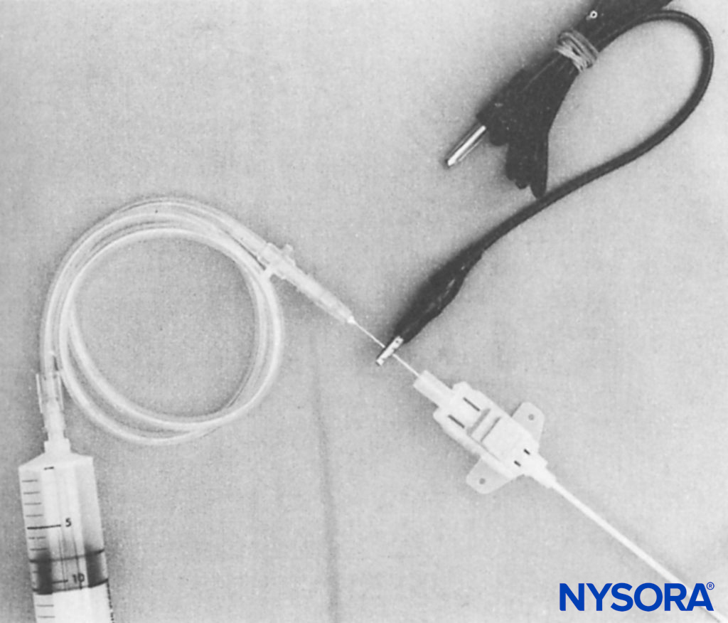 Assembly shows a 21-gauge needle inserted into the proximal end of the 16-gauge Secalon (Viggo, Sweden) central venous pressure catheter. Metal contact of the smaller needle inside the larger needle allows an electrical impulse to be conveyed to the Secalon needle tip. An alligator clip from the electrical stimulator is attached to the shaft of the 21-gauge needle. Intravenous extension tubing inserts into the hub of the 21-gauge needle. (Reproduced with permission from Ben-David B1, Lee E, Croitoru M: Psoas block for surgical repair of hip fracture: a case report and description of a catheter technique. Anesth Analg. 1990 Sep;71(3):298-301.)