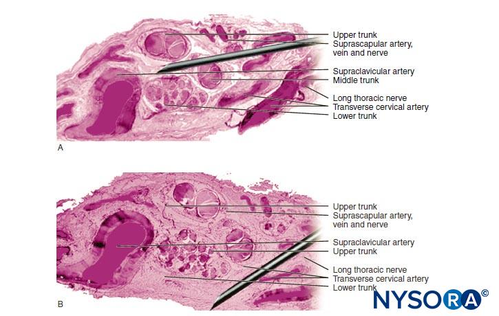 Complications And Prevention Of Neurologic Injury With Peripheral Nerve Blocks Nysora Complications And Prevention Of Neurologic Injury With Peripheral Nerve Blocks Nysora