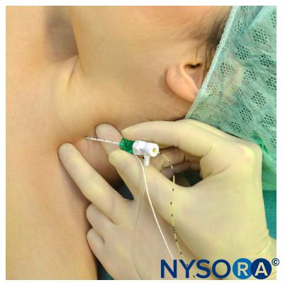 Continuous interscalene brachial plexus block. The needle is inserted between anterior and middle scalene muscles in the pictured direction. The needle should not be placed deeper than 2-3 cm in most patients.