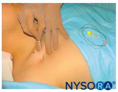 Raj approach: Needle insertion and orientation.