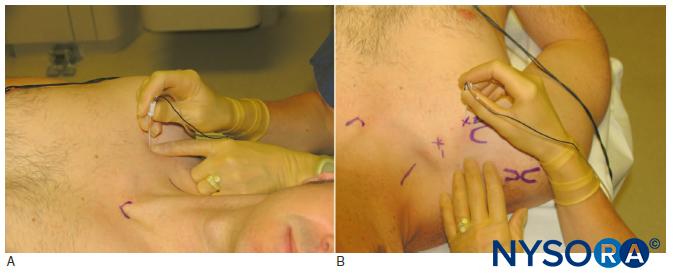 A and B Vertical approach: Needle insertion and orientation.
