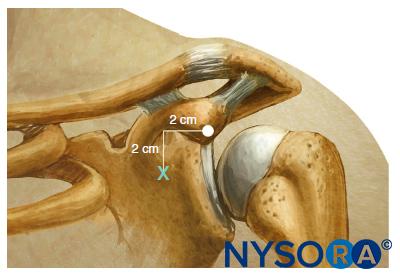 Coracoid approach: Landmarks.