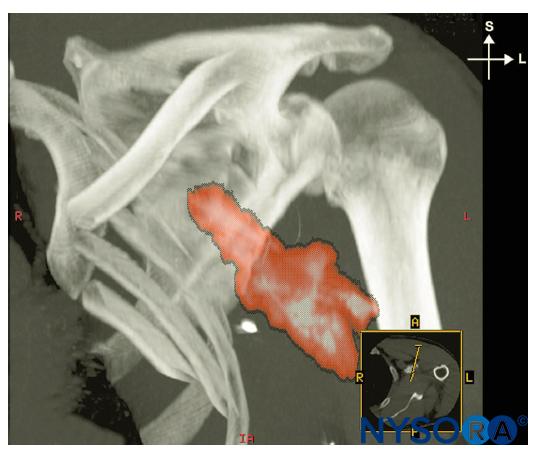 Distribution of the local anesthetic after injection through an indwelling catheter.