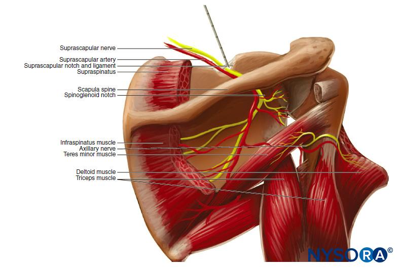 Suprascapular nerve block. The suprascapular nerve is blocked as it emerges from the suprascapular notch. Directing the needle caudally substantially reduces the risk of pneumothorax.