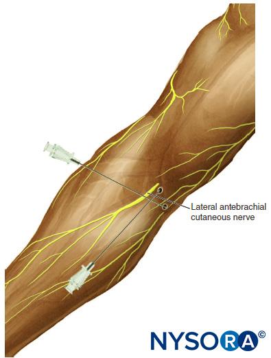 Blocks of the lateral and medial antebrachial cutaneous nerve. Anesthesia for lateral antebrachial cutaneous nerve requires two injections. The first deposits 5 mL local