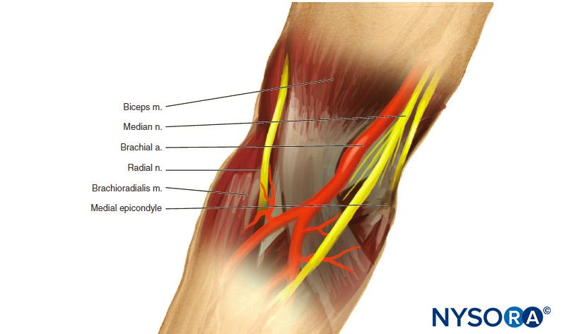 Radial and median nerves are approached at the level of the epicondyles. The radial nerve is found approximately 1.5 cm lateral to the biceps tendon. The median nerve is more superficial and identified by a needle placed just medial to the brachial artery.