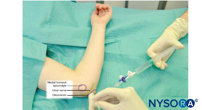 Ulnar nerve block at the elbow. The forearm is flexed, the ulnar groove identified, and a needle is placed 1 cm proximal to the epicondyles and directed distally.