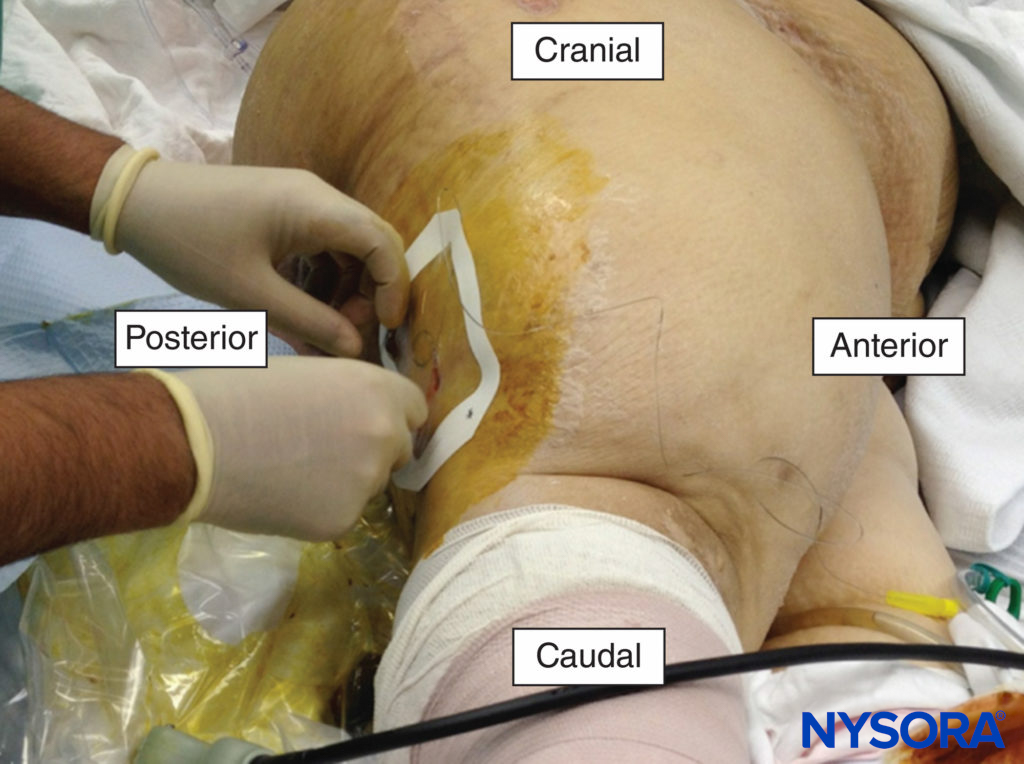 A popliteal catheter being placed for the management of pain following a traumatic amputation of the foot.
