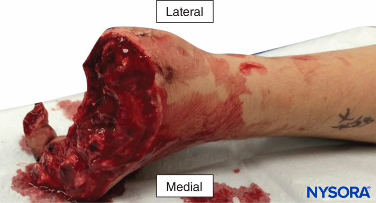 Multiple digital amputations resulting from an industrial accident. An infraclavicular catheter was placed preoperatively and local anesthetic infused for 6 days. All four fingers that were replanted survived with good function.