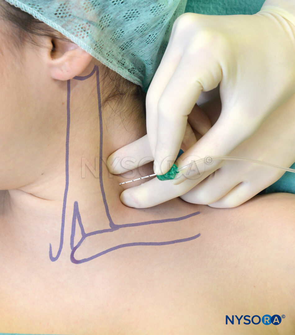 Interscalene Brachial Plexus Block - Landmarks and Nerve