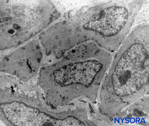 Arachnoid cells in the thickness of arachnoid layer. Transmission electron microscopy. Magnification ×4400. (Reproduced with permission from Raj P: Textbook of Regional Anesthesia. Philadelphia: Churchill Livingstone; 2002.)