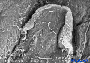Dura-arachnoid lesion produced with 25-G Quincke needle. Epidural surface. Scanning electron microscopy. Magnification ×150. (Reproduced with permission from Reina MA, Castedo J, López A. Cefalea pospunción dural: Ultraestructura de las lesiones durales y agujas espinales usadas en las punciones lumbares. Rev Arg Anestesiol. 2008 Jan-Mar 66(1):6-26.)