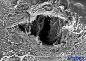 Dura-arachnoid lesion produced with 25-G Whitacre needle. Epidural surface. Scanning electron microscopy. Magnification ×200. (Reproduced with permission from Reina MA, López-García A, de Andrés-Ibáñez JA, et al: Electron microscopy of the lesions produced in the human dura mater by Quincke beveled and Whitacre needles. Rev Esp Anestesiol Reanim. 1997 Feb;44(2):56-61.)