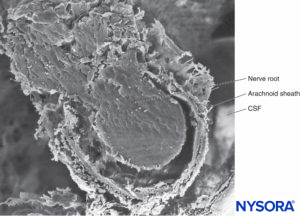 Trabecular arachnoid layer. The projections of trabecular arachnoid that cover nerve roots are called arachnoid sheaths. CSF = cerebrospinal fluid. Scanning electron microscopy. Magnification ×100. (Reproduced with permission from Reina MA, López A, De Andrés JA: Hypothesis concerning the anatomical basis of cauda equina syndrome and transient nerve root irritation after spinal anesthesia. Rev Esp Anestesiol Reanim. 1999 Mar;46(3):99-105.)