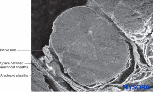 Nerve root and arachnoid sheath. Scanning electron microscopy. Magnification ×60. (Reproduced with permission from Torres LM: Textbook of Anesthesia and Pain Management. Aran Ed; 2001.)