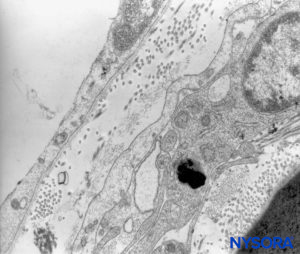 Human pia mater. Detail of pial cells. Transmission electron microscopy. Magnification ×12,000. (Reproduced with permission from Reina MA, Wikinski J, De Andrés JA: Una rara complicación de la anestesia epidural y subaracnoidea. Tumores epidermoideos espinales iatrogénicos. Rev Arg Anestesiol. 2008;66:319-336.)