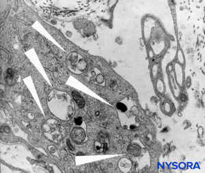 Detail of macrophagic cells in spinal pia mater. Transmission electron microscopy. Magnification ×12,000. (Reproduced with permission from Reina MA, Wikinski J, De Andrés JA: Una rara complicación de la anestesia epidural y subaracnoidea. Tumores epidermoideos espinales iatrogénicos. Rev Arg Anestesiol. 2008;66:319-336.)