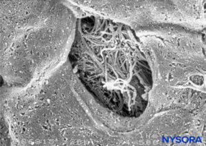 Detail of fenestration in human pia mater. Scanning electron microscopy. Magnification ×1500. (Reproduced with permission from Reina MA, López García A, de Andrés JA: Anatomical description of a natural perforation present in the human lumbar pia mater. Rev Esp Anestesiol Reanim. 1998;45:4-7.)