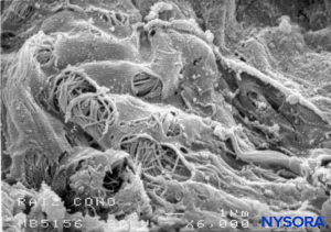 Fenestrations in human pia mater of nerve root. Scanning electron microscopy. Magnification ×6000. (Reproduced with permission from Reina MA, Villanueva MC, López A: Aracnoides trabecular, piamadre espinal humana y anestesia subaracnoidea. Rev Arg Anestesiol. 2008;66:111–133.)