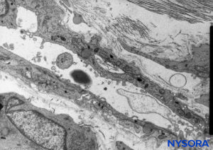 Neurothelial cells in the subdural compartment. Transmission electron microscopy. Magnification ×5000. (Reproduced with permission from Reina MA, De León Casasola OA, et al: The origin of the spinal subdural space. Ultrastructure finding. Anesth Analg. 2002 Apr;94(4):991-995.)