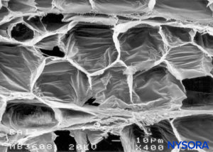 Human nerve root cuff. Adipocytes in nerve root cuff. Scanning electron microscopy. Magnification ×400. (Reproduced with permission from Reina MA, Villanueva MC, Machés F, et al: Ultrastructure of human spinal nerve root cuff in lumbar spine. Anesth Analg. 2008 Jan;106(1):339-344.)