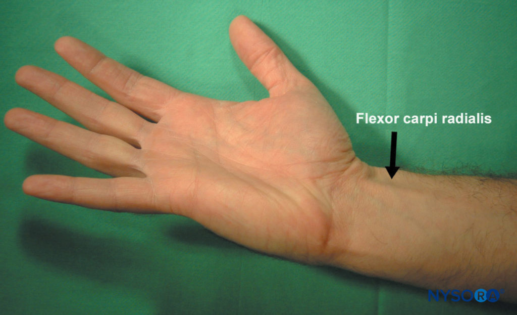 Bloc de poignet - Repère et technique de stimulation nerveuse - NYSORA