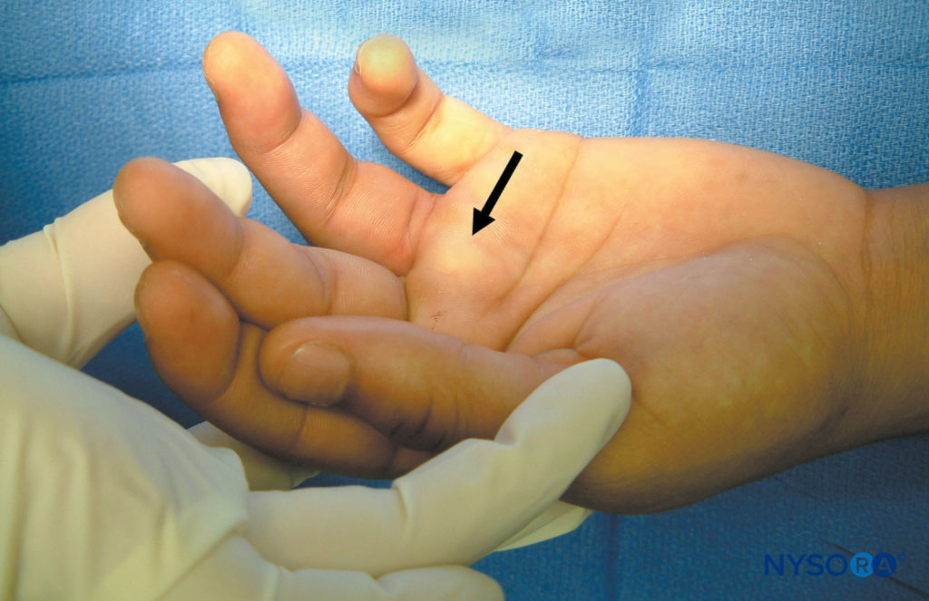 Angle of needle insertion for transthecal digital block.