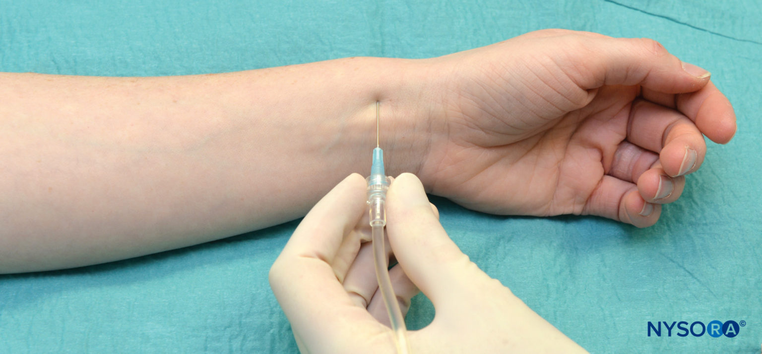 Wrist Block Landmarks and Nerve Stimulator Technique NYSORA