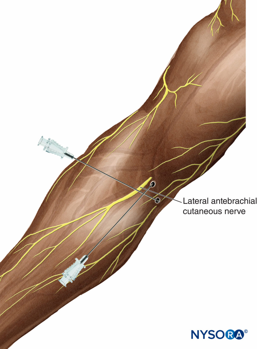 Cutaneous Blocks for the Upper Extremity Landmarks and Nerve