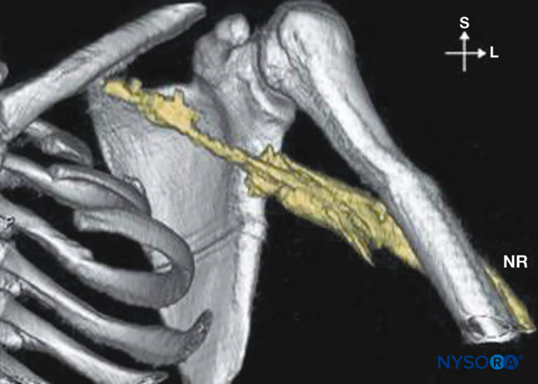 Axillary Brachial Plexus Block Landmarks and Nerve Stimulator