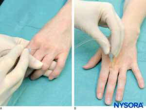 Digital Block - Landmarks and Nerve Stimulator Technique - NYSORA