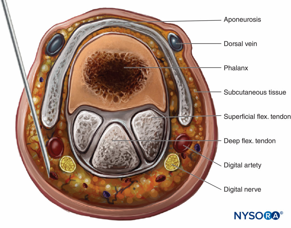 The needle is shown inserted at the base of the proximal phalanx to block the medial digital nerve.