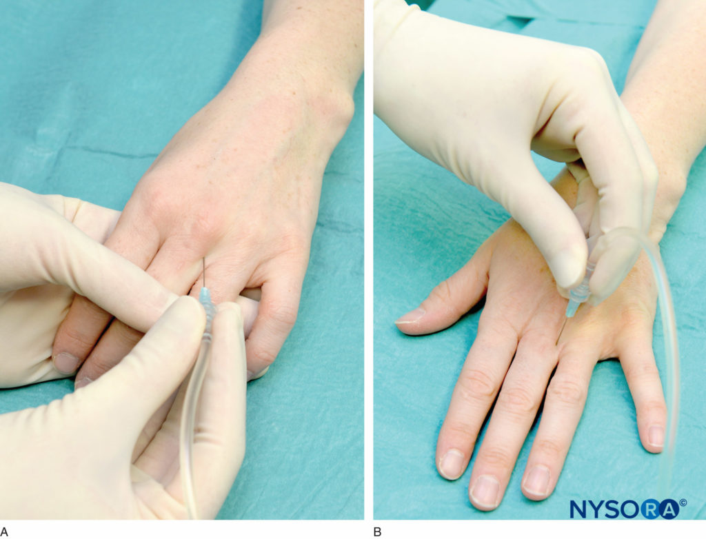 As the needle is inserted and injection is being made, the operator observes the palmar area to stop the advancement of the needle should a protrusion from the palmar dermis opposite the nerve tip be seen.