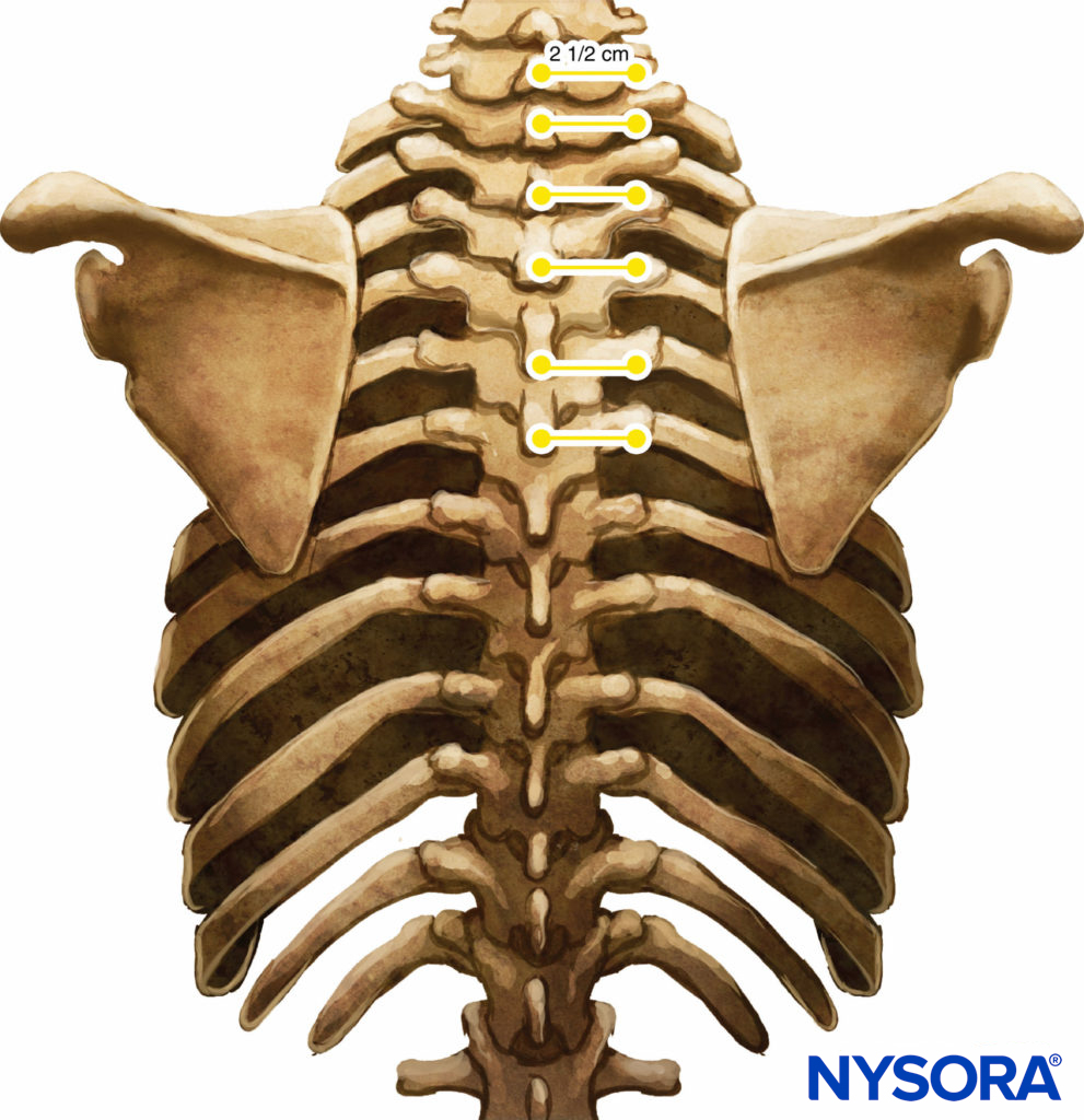 Relationship between spinous and transverse processes.