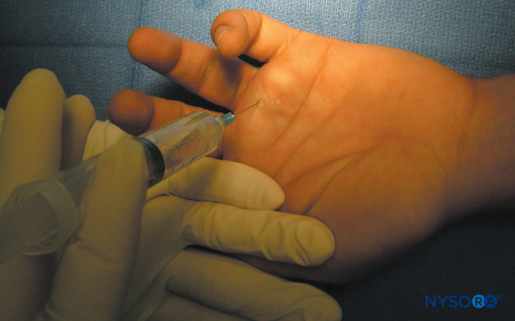 Transthecal digital block. The needle is placed into the flexor tendon sheath. To confirm the correct needle placement in the tendon sheath, the needle can be placed without the syringe, in which case the operator flexes and deflexes the finger. This should result in a free and substantial swinging of the needle.