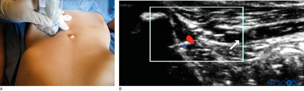 Bloqueo del nervio ilioinguinal/iliohipogástrico: (A) posición de la sonda; (B) imagen de EE.UU.