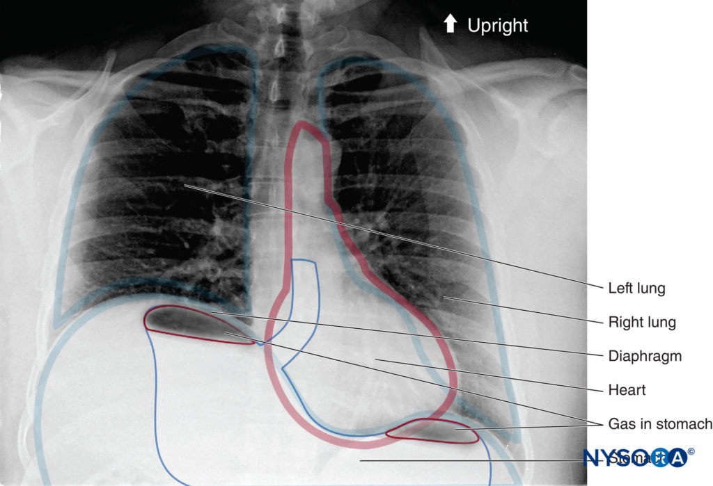 Radiographie thoracique droite d'un patient ayant subi un bloc du plexus brachial interscalénique droit. Notez l'hémidiaphragme droit surélevé.