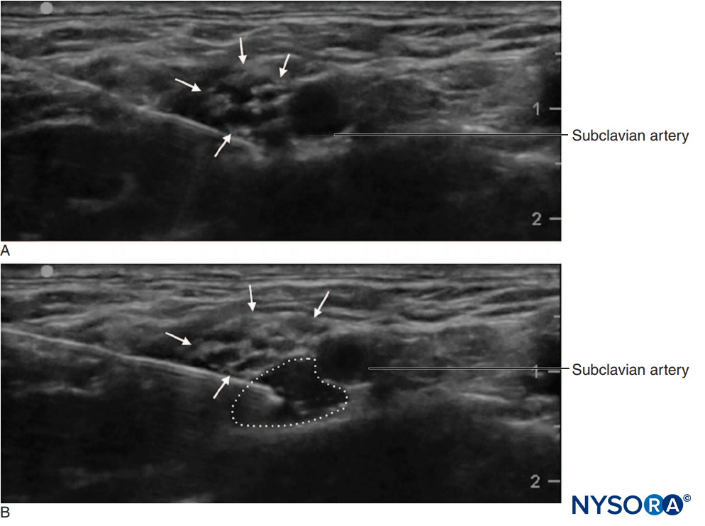 Supraclavicular brachial plexus block showing plexus (arrows) adjacent to subclavian artery (SA). A Before and B after deposition of 10 mL of local anesthetic (dotted outline).