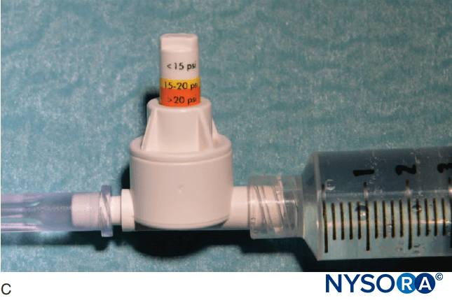 An example of a commercially available in-line pressure manometer (B-Smart, B. Braun Medical, Bethlehem, PA). As seen in A–C, respectively, the monitor displays pressure ranges in color on the movable piston: 0–15 psi (white), 15–20 psi (yellow), and more than 20 psi (orange). In clinical use, the exact opening injection pressure (OIP) is less important than prevention of exceeding the range of OIP associated with fascicular injury (>15 psi). Practically, this is avoided by aborting the injection with appearance of any color on the piston throughout the injection cycle (>15 psi). Importantly, opening pressure (pressure at which the flow begins) is independent of the size of the syringe, tubing, and needle or injection speed (Pascal’s law)