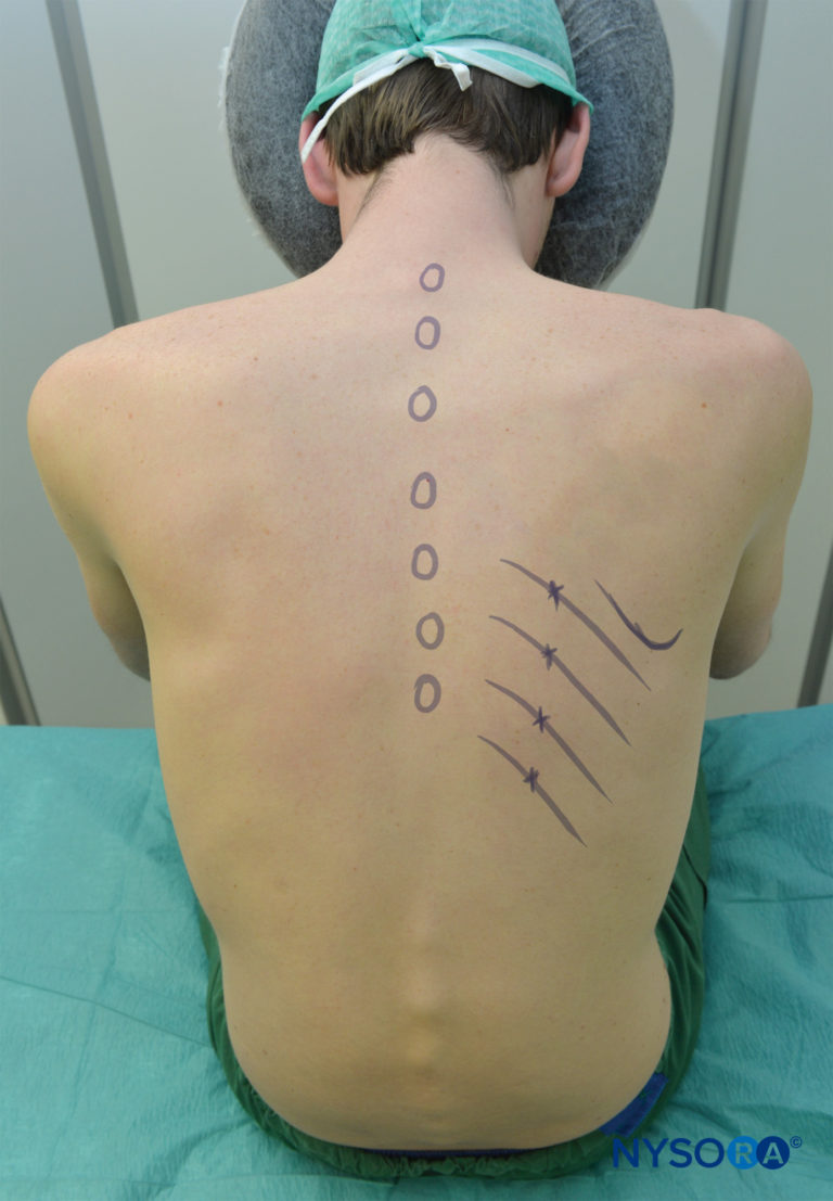 Intercostal Nerve Block Landmarks and Nerve Stimulator Technique NYSORA