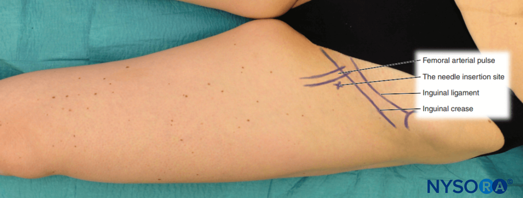Anatomic landmarks for femoral nerve block. The needle insertion site (X) is located just below the inguinal crease, 1–2 cm lateral to the pulse of the femoral artery.