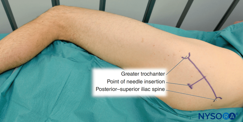 Sciatic nerve block, posterior approach.