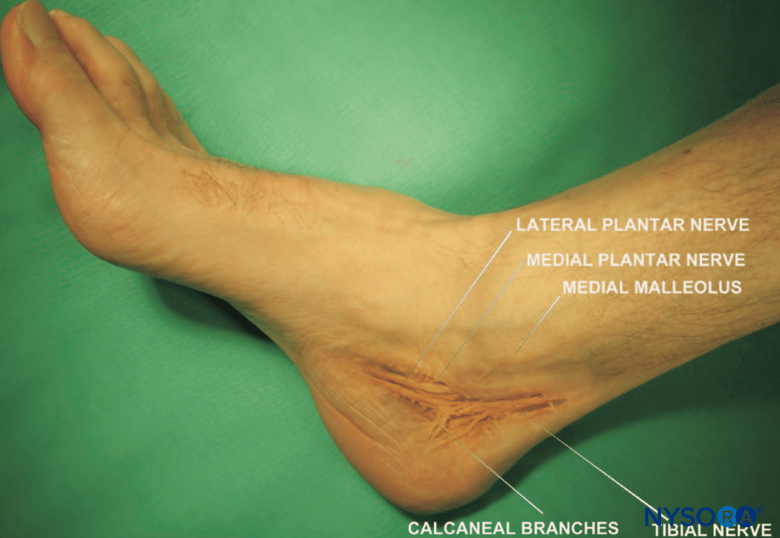 Lateral Plantar Nerve Block