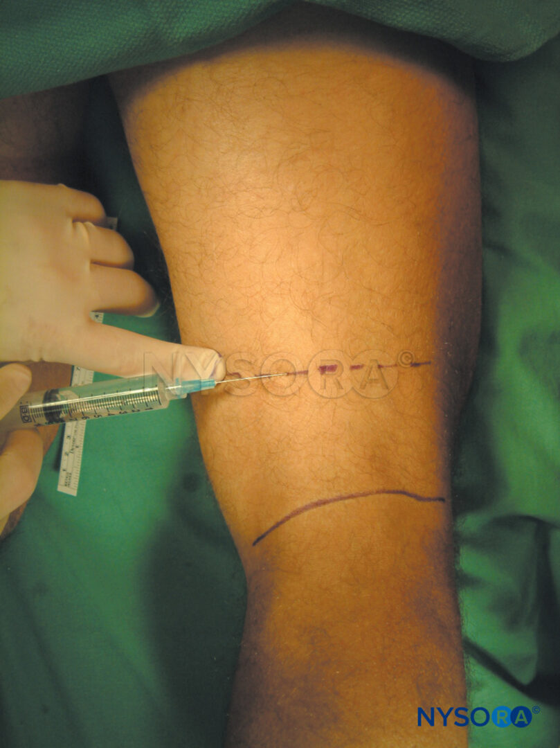 saphenous nerve knee