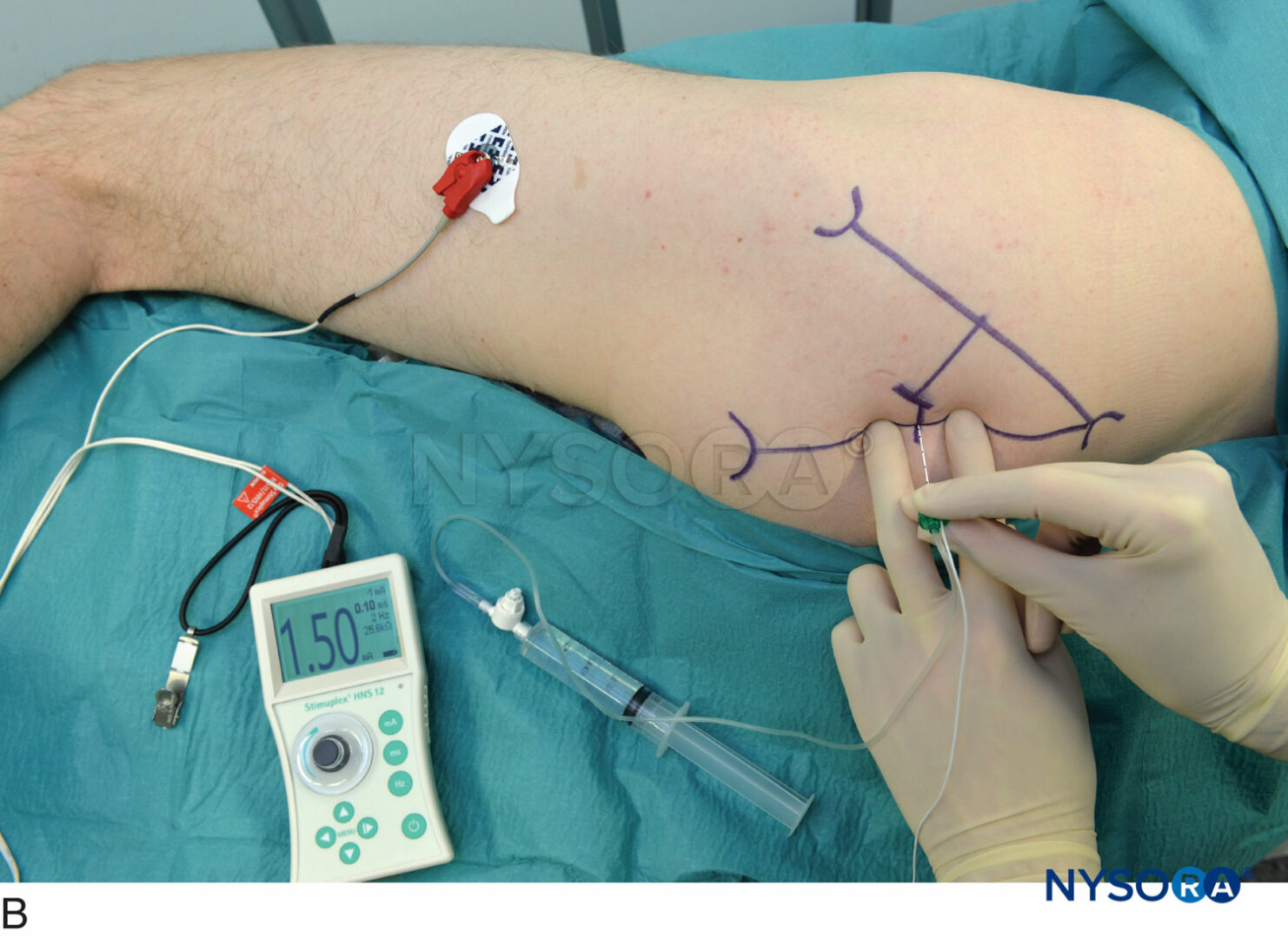 sciatic nerve block anterior approach