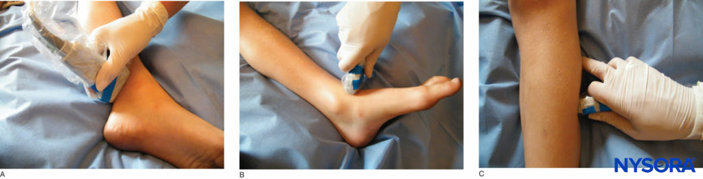 Transducer position for a block of the (A) posterior tibial nerve; (B) superficial peroneal nerve; and (C) deep peroneal nerve.