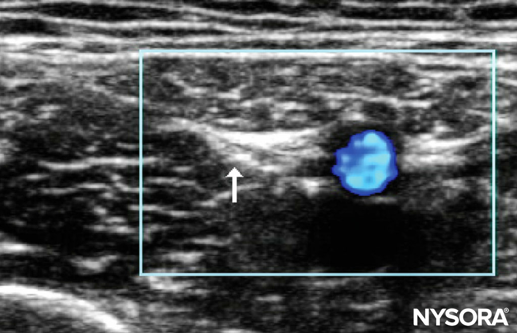 Subsartorial saphenous nerve block.