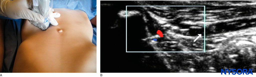 Ilioinguinal/iliohypogastric nerve block: (A) probe position; (B) US image.