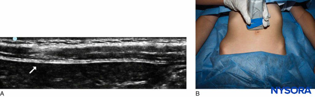 Neonatal rectus sheath block: (A) sonoanatomy; (B) probe position.